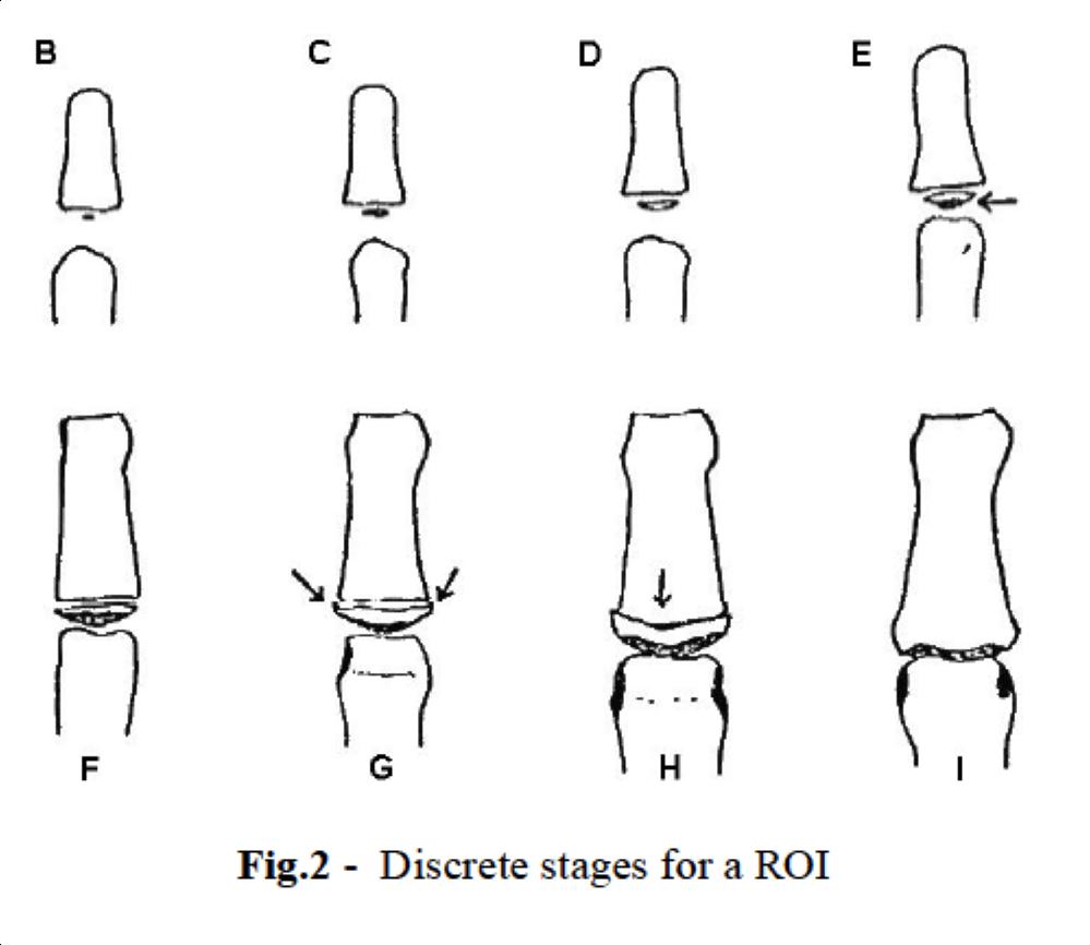 Adolescent Idiopathic Scoliosis Spine Orthobullets